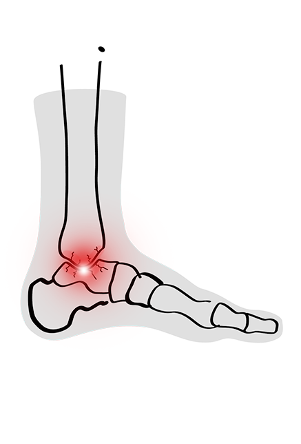 ANKLE AND FOOT ARTHROPATHIES