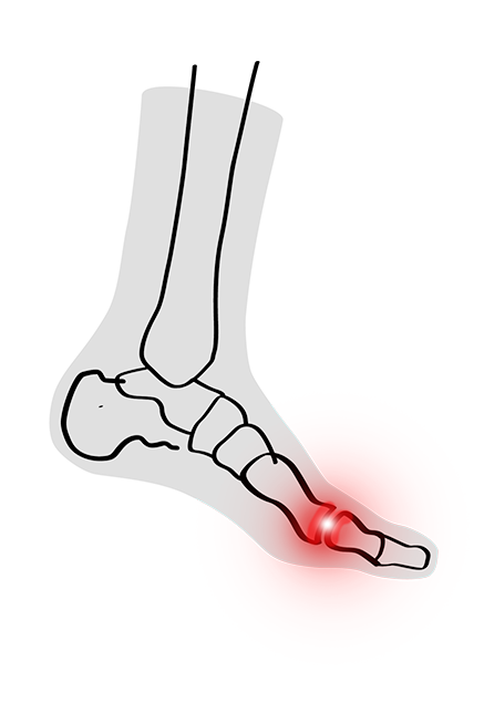HALLUX RIGIDUS