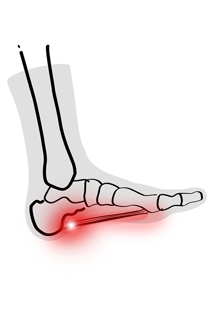 PLANTAR FASCIITIS