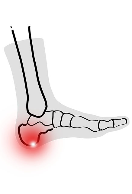 PLANTAR HEEL PAIN