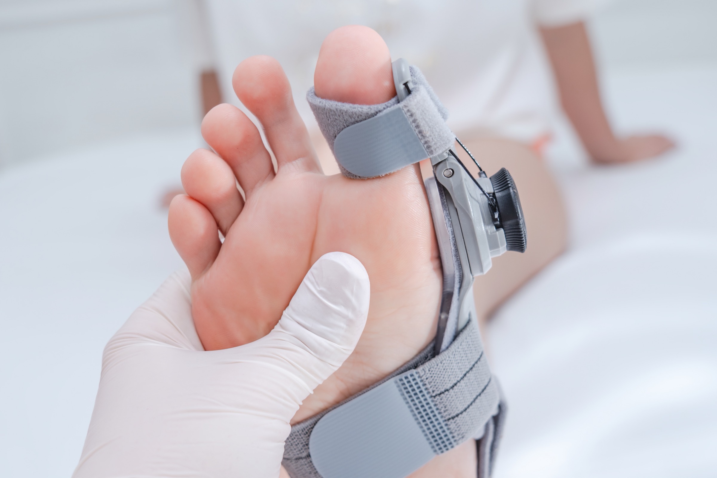 How are Bunions Treated?
