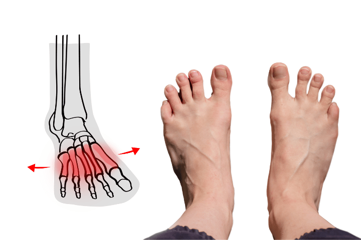 What Does Splayfoot Mean in Everyday Life?