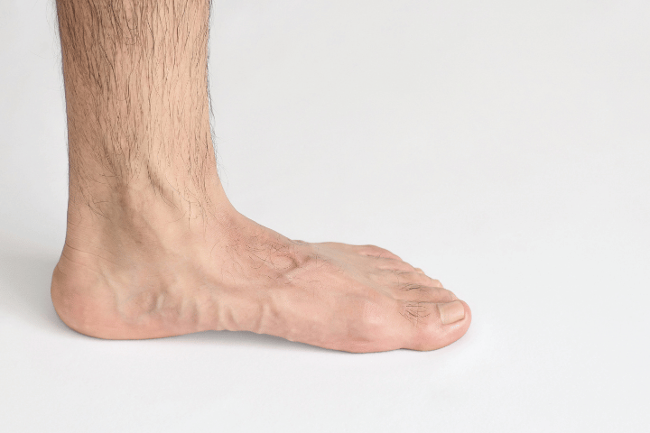 What Can Splayfoot Insoles Do?