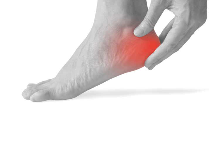 What Is a Heel Spur