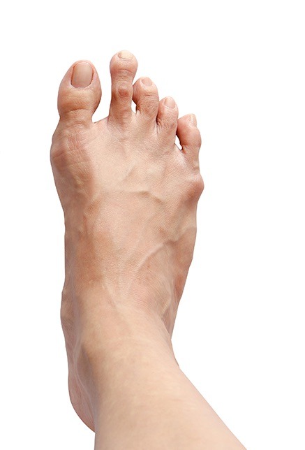 What is Morton’s Toe